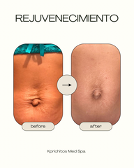 Paquete de Fibroblast - Abdomen