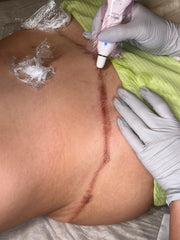 Paquete de Fibroblast - Abdomen