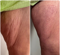 Paquete de Fibroblast - Entre piernas