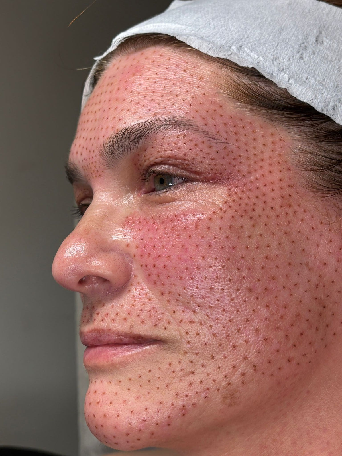 Fibroblast Sesión Individual - Rostro – K-prichitos LLC