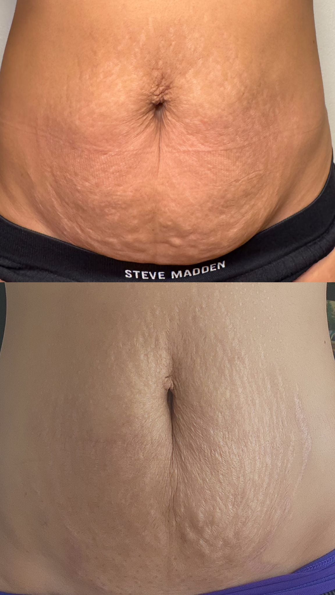 Paquete de Fibroblast - Abdomen